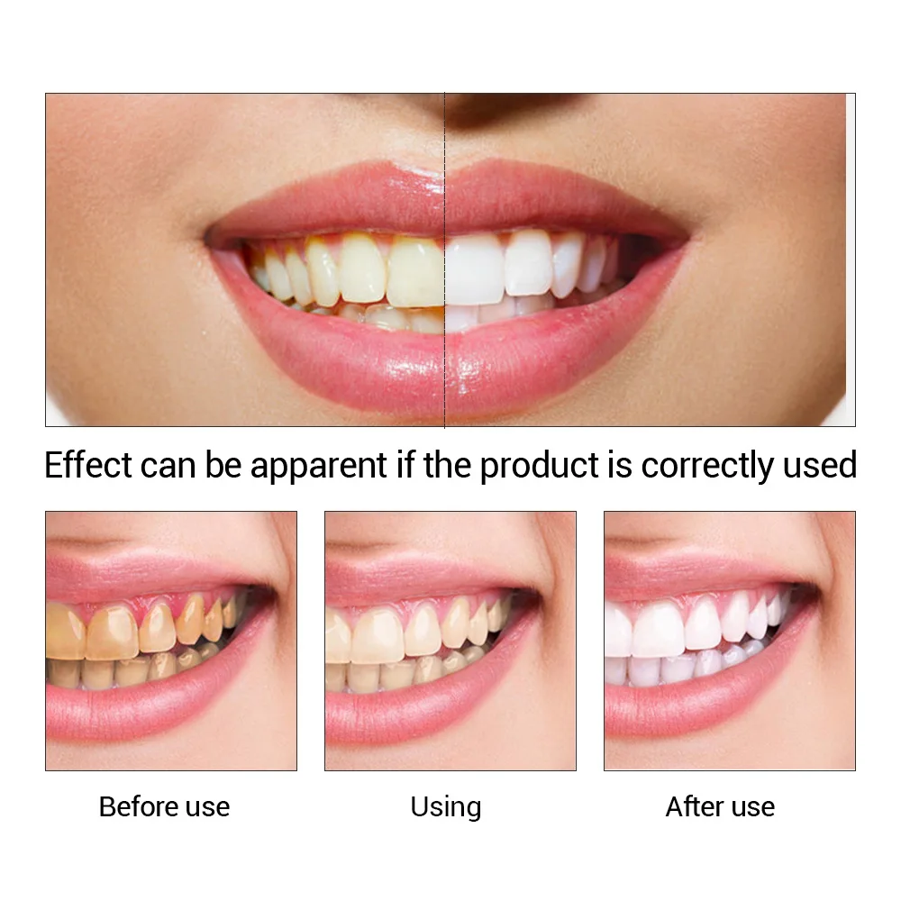 FTEENPLY diş beyazlatma özü to - Teeth Whitening Ulta incelemesi ve fiyatı