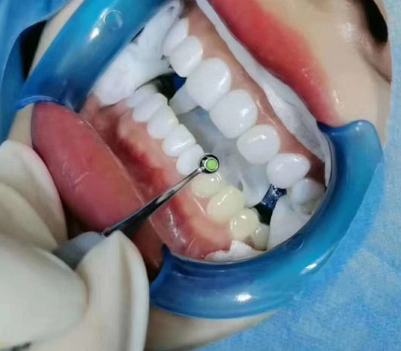 Diş Reçine Dolum Spatula Diş K - Teeth Whitening Foam Toothpaste incelemesi ve fiyatı